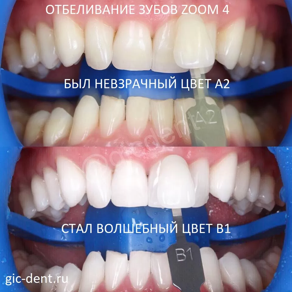Отбеливание зубов в Немецком имплантологическом центре по технологии ZOOM 4